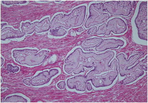 Prostate Well differentiated adenocarcinoma